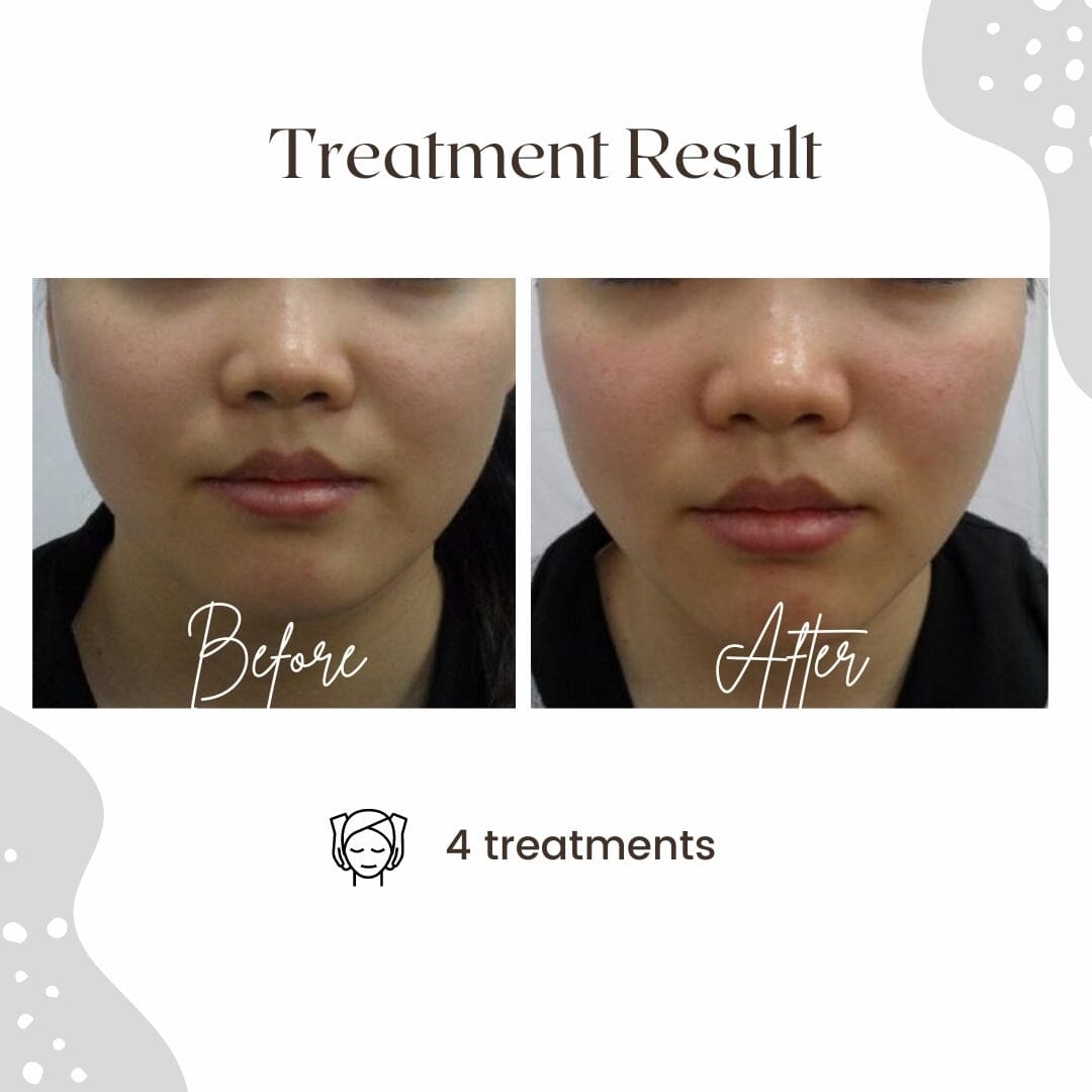 RF LAB - Radio Frequency + Vacuum Suction + LED Color Therapy DEVICE HistoLab Medical Skincare