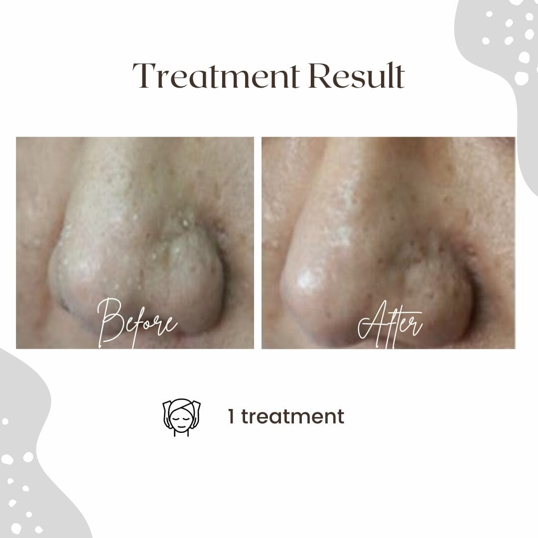 AQUA LAB - Deep Cleaning & Peeling Device (Korean Hydro Facial) Professional HistoLab Medical Skincare