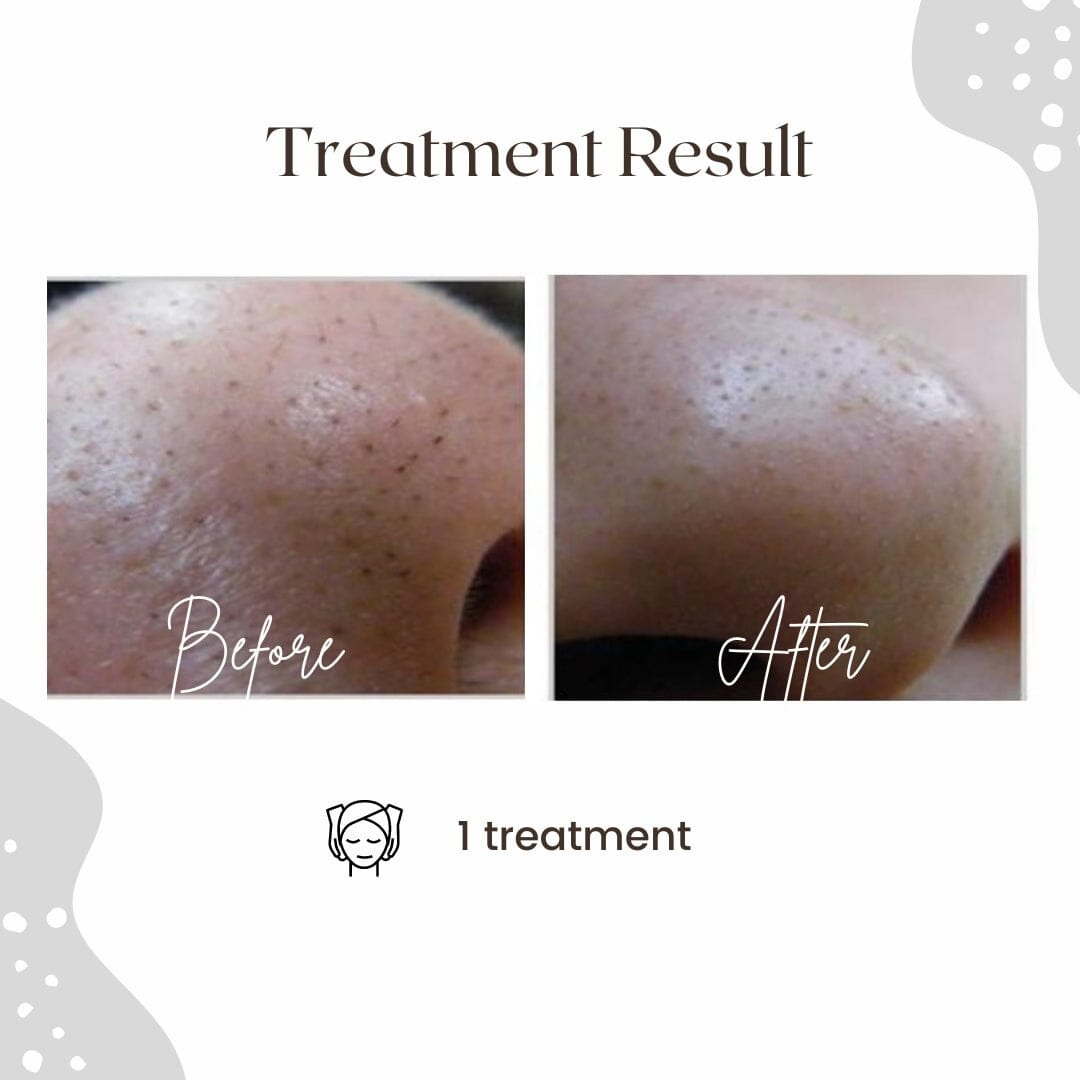 AQUA LAB - Deep Cleaning & Peeling Device (Korean Hydro Facial) Professional HistoLab Medical Skincare