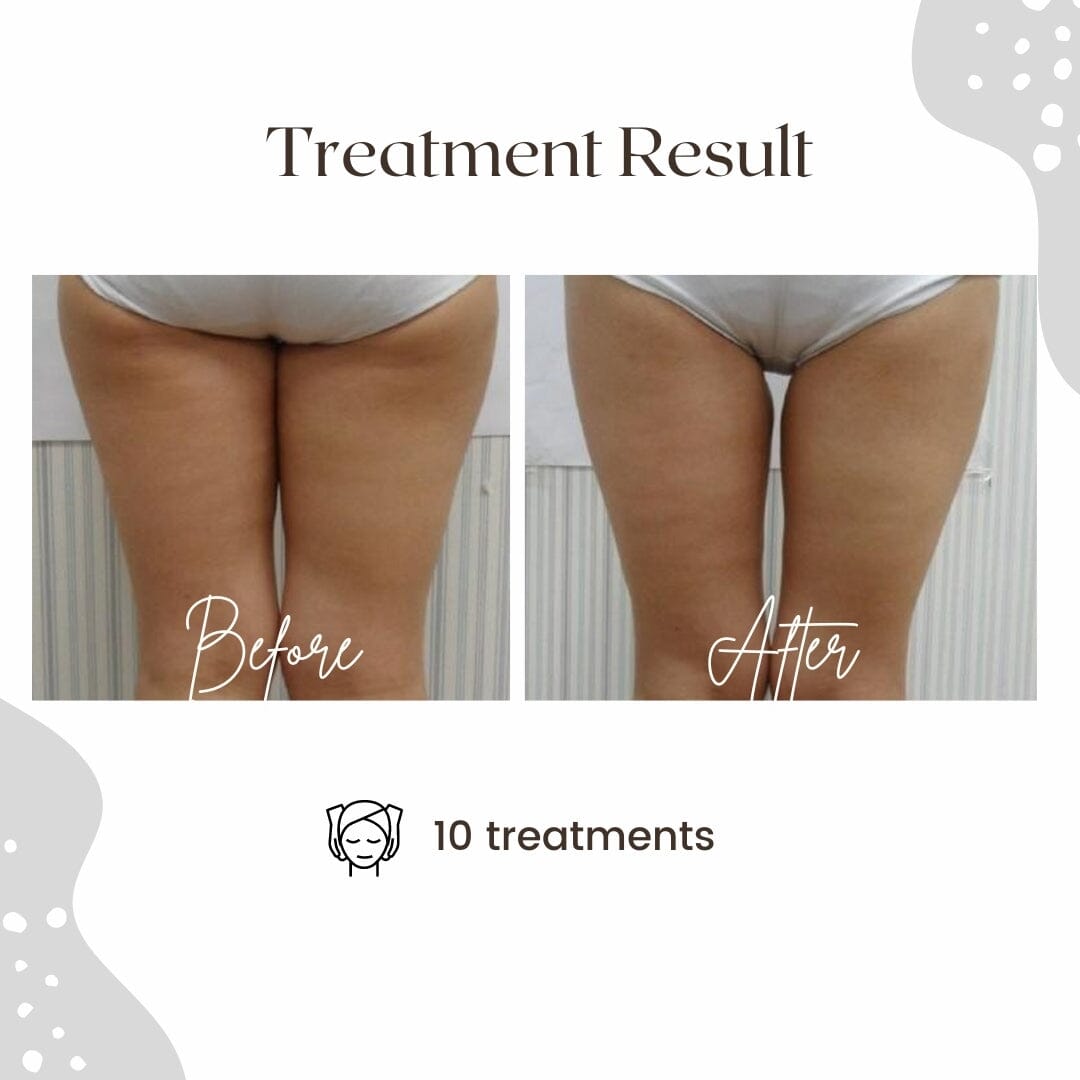 RF LAB - Radio Frequency + Vacuum Suction + LED Color Therapy DEVICE HistoLab Medical Skincare