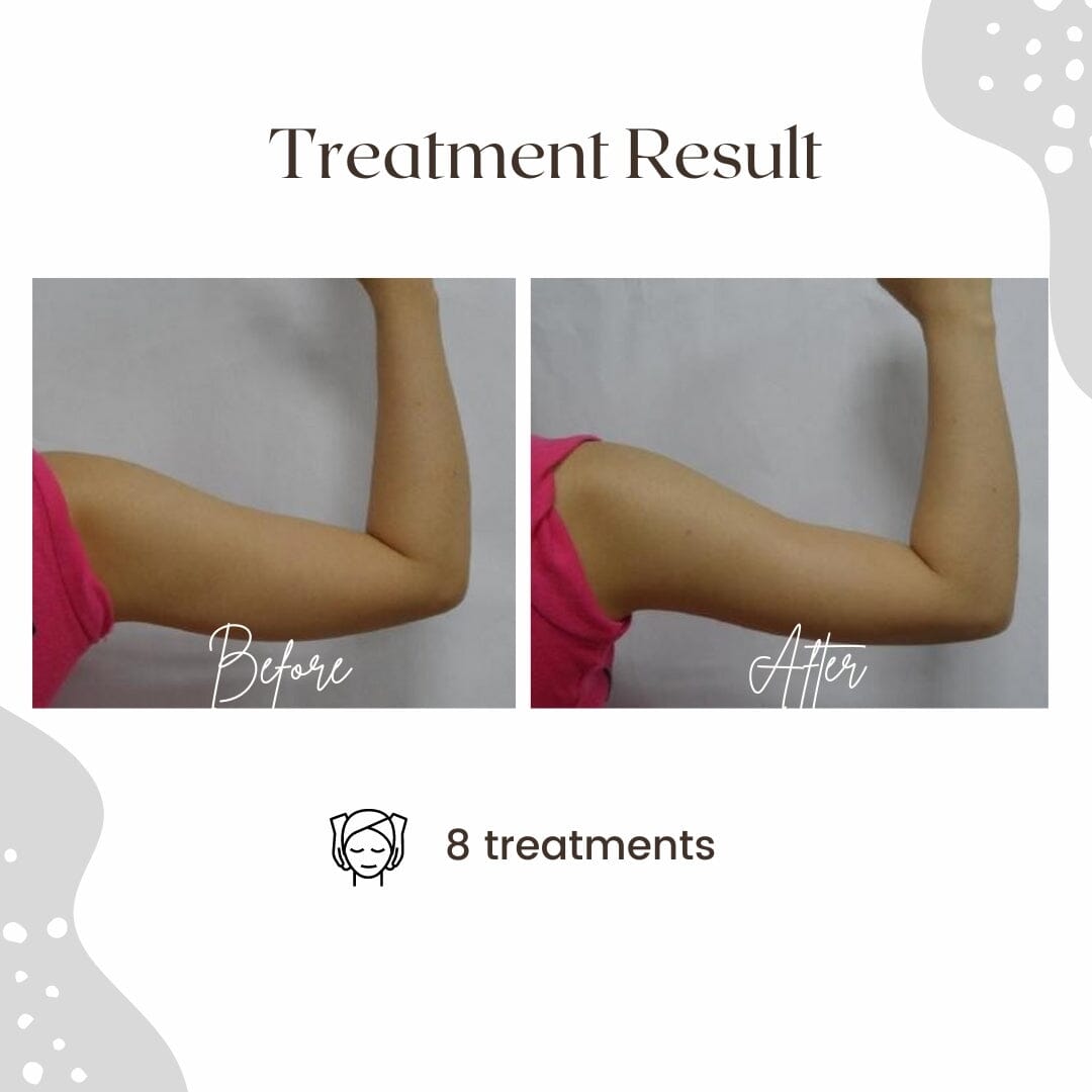 RF LAB - Radio Frequency + Vacuum Suction + LED Color Therapy DEVICE HistoLab Medical Skincare