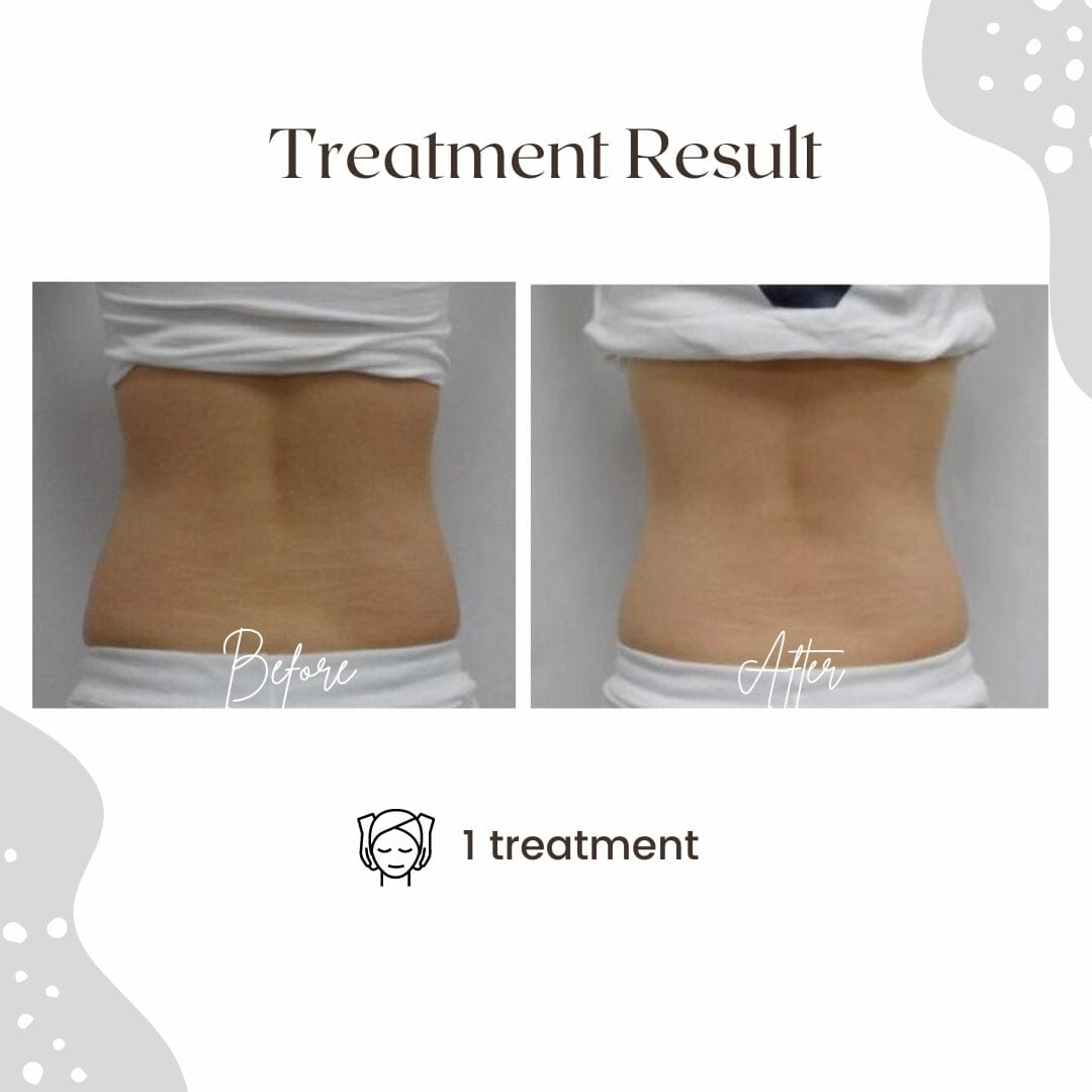 RF LAB - Radio Frequency + Vacuum Suction + LED Color Therapy DEVICE HistoLab Medical Skincare