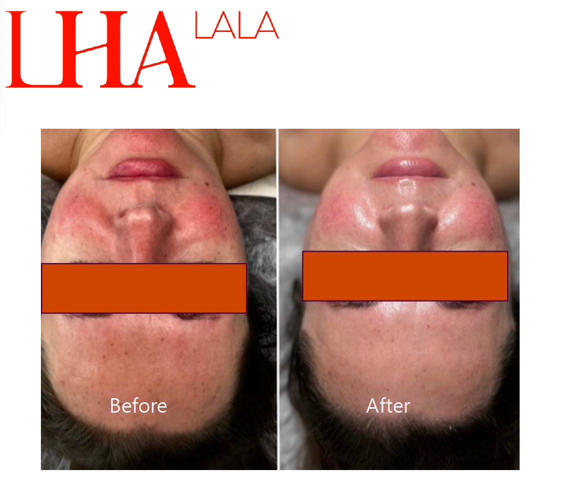 LHALA Peel