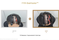 P198 ExoHealer™ FILCORE HB PLUS（2 mL × 5 Vials）