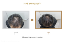 P198 ExoHealer™ FILCORE HB PLUS（2 mL × 5 Vials）